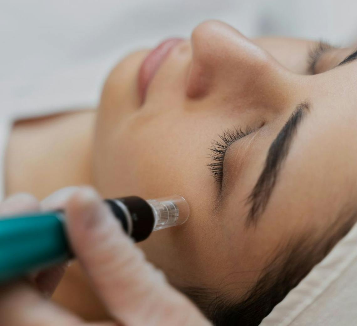 soin du visage microneedling avant/après
