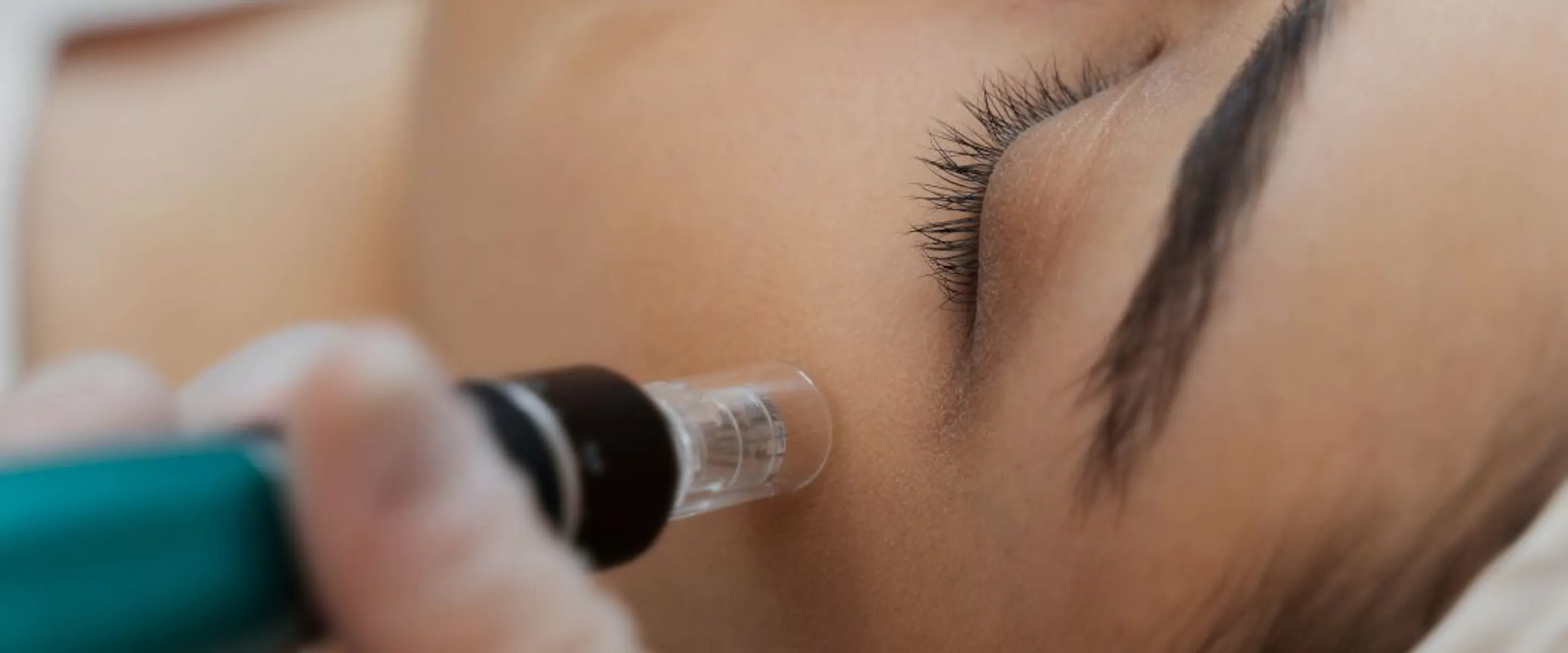 Microneedling au rétinol : le soin anti-rides régénérant