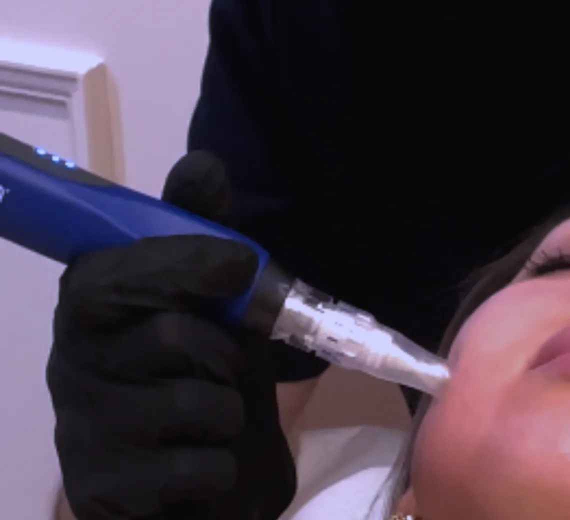 prendre soin de sa peau avec un microneedling