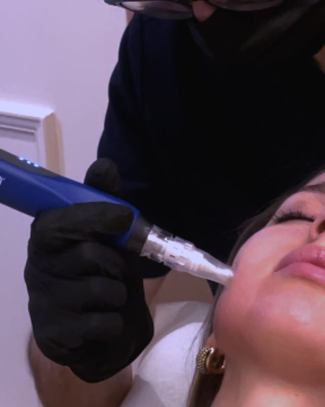 seance microneedling lyon maison yoko