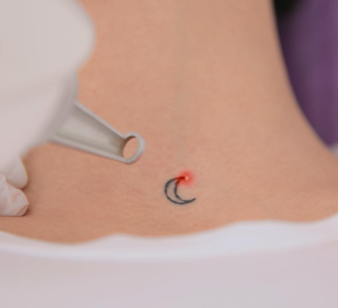 DĂ©tatouage laser lyon : patiente en sĂ©ance de dĂ©tatouage laser chez Maison YokĆ Lyon.