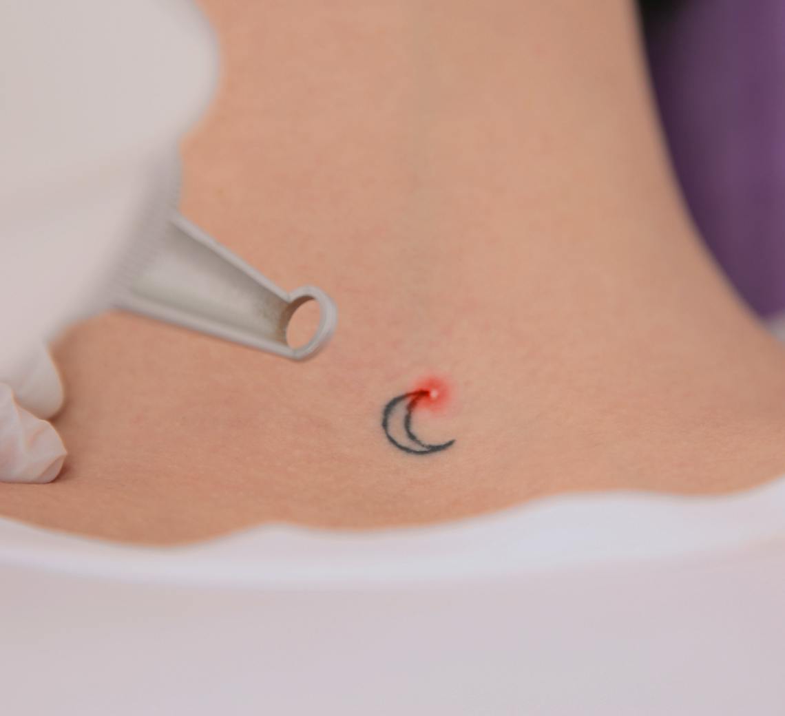 Détatouage laser lyon pour Retirer un tatouage