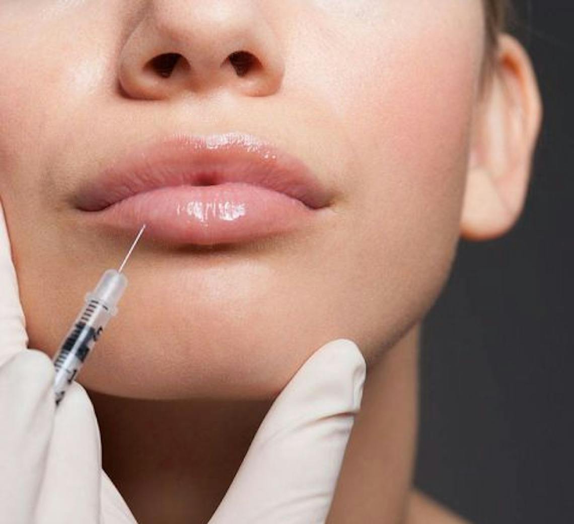 Jeune femme qui se fait injecter à l'aide d'une aiguille au niveau de la lèvre inférieure.