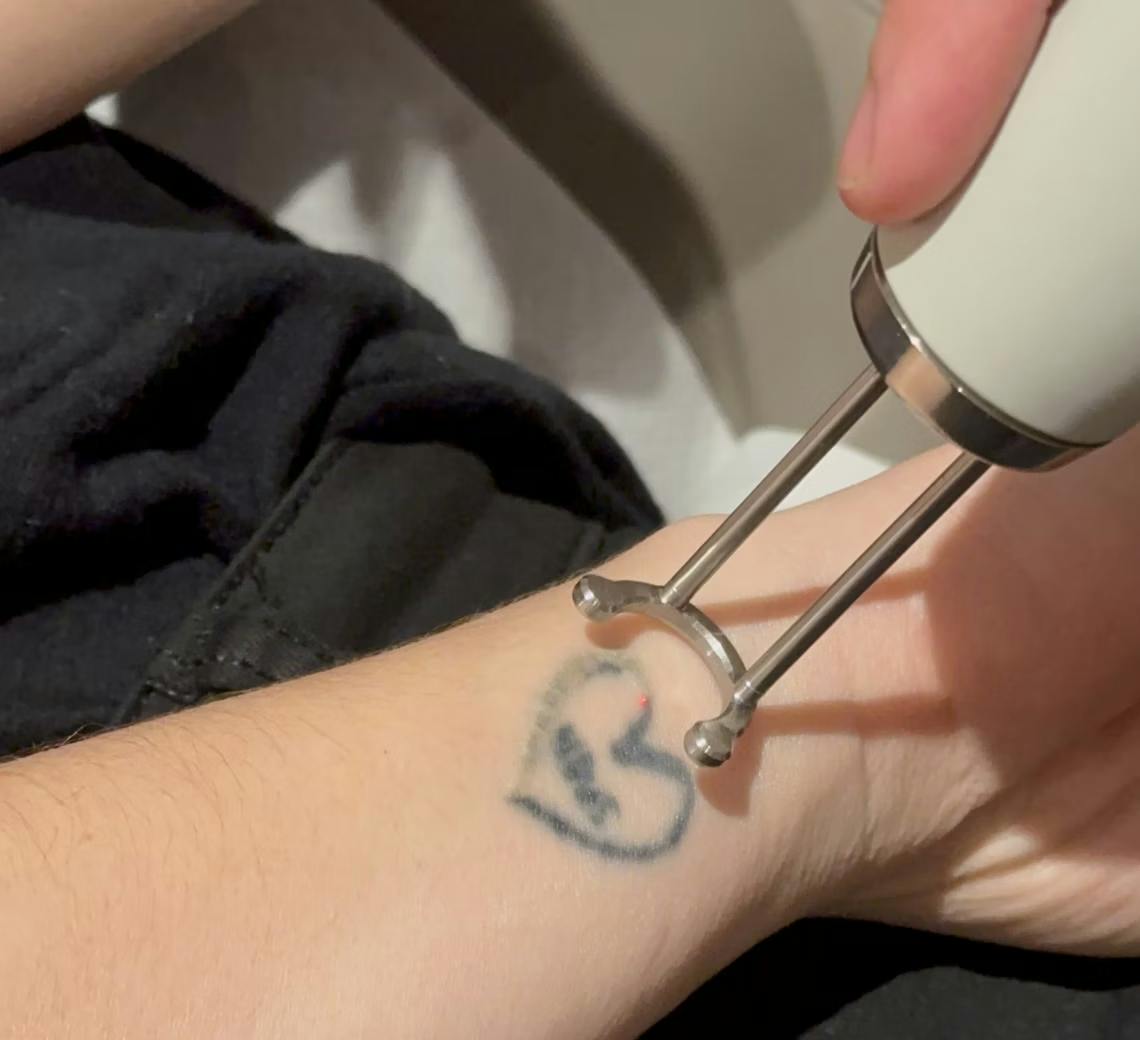 Détatouage laser après 5 séances