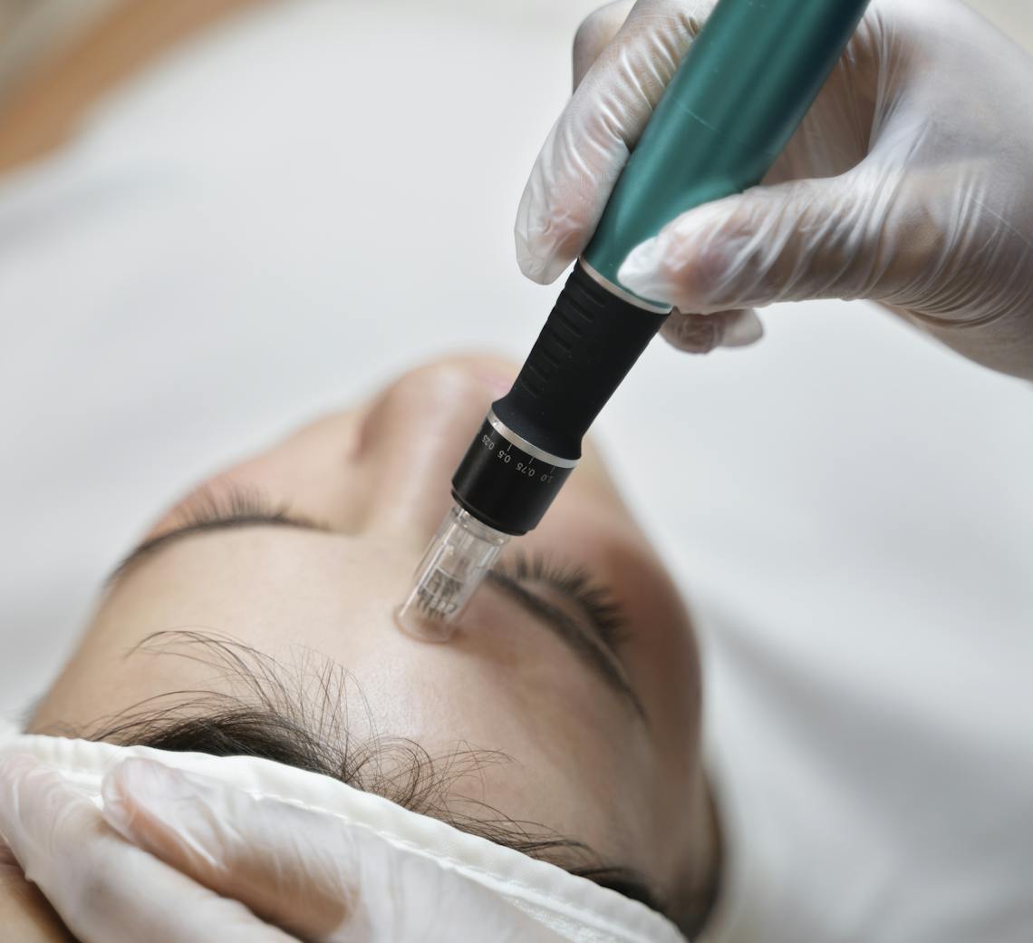 microneedling contre le teint terne et fatigué