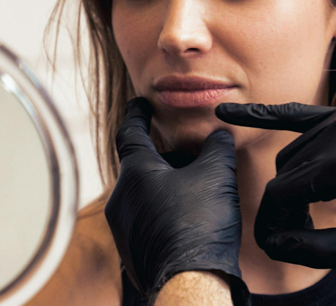 radiofréquence microneedling lyon