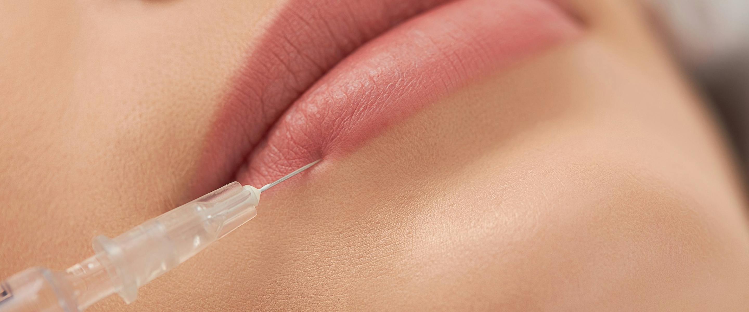 Acide hyaluronique lèvres lyon