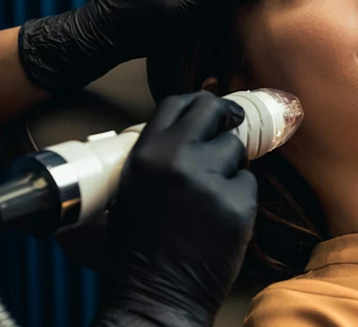 radiofréquence microneedling pour l'ovale du visage