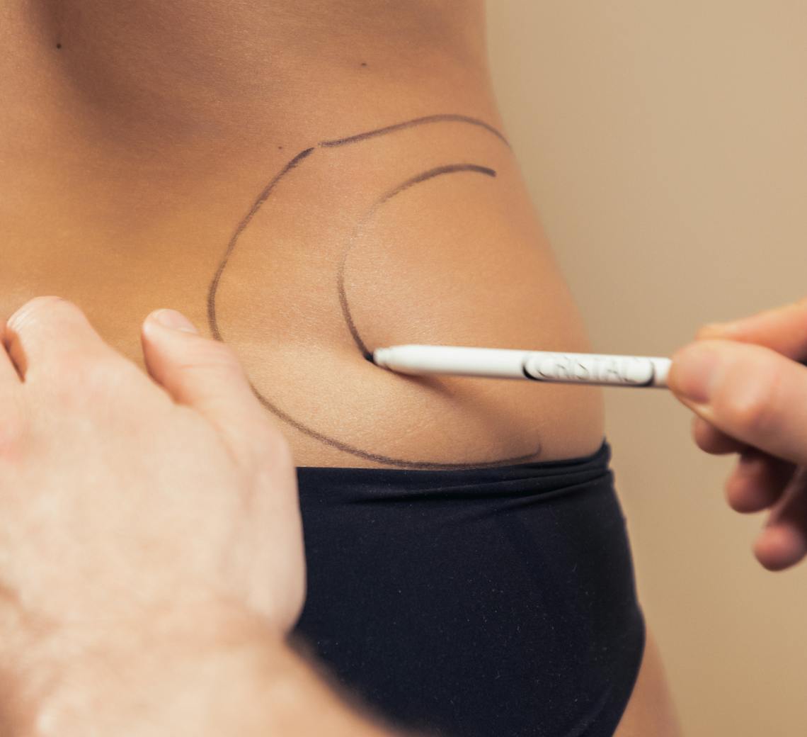 Focus cryolipolyse bas du dos chez Maison Yoko Lyon 2