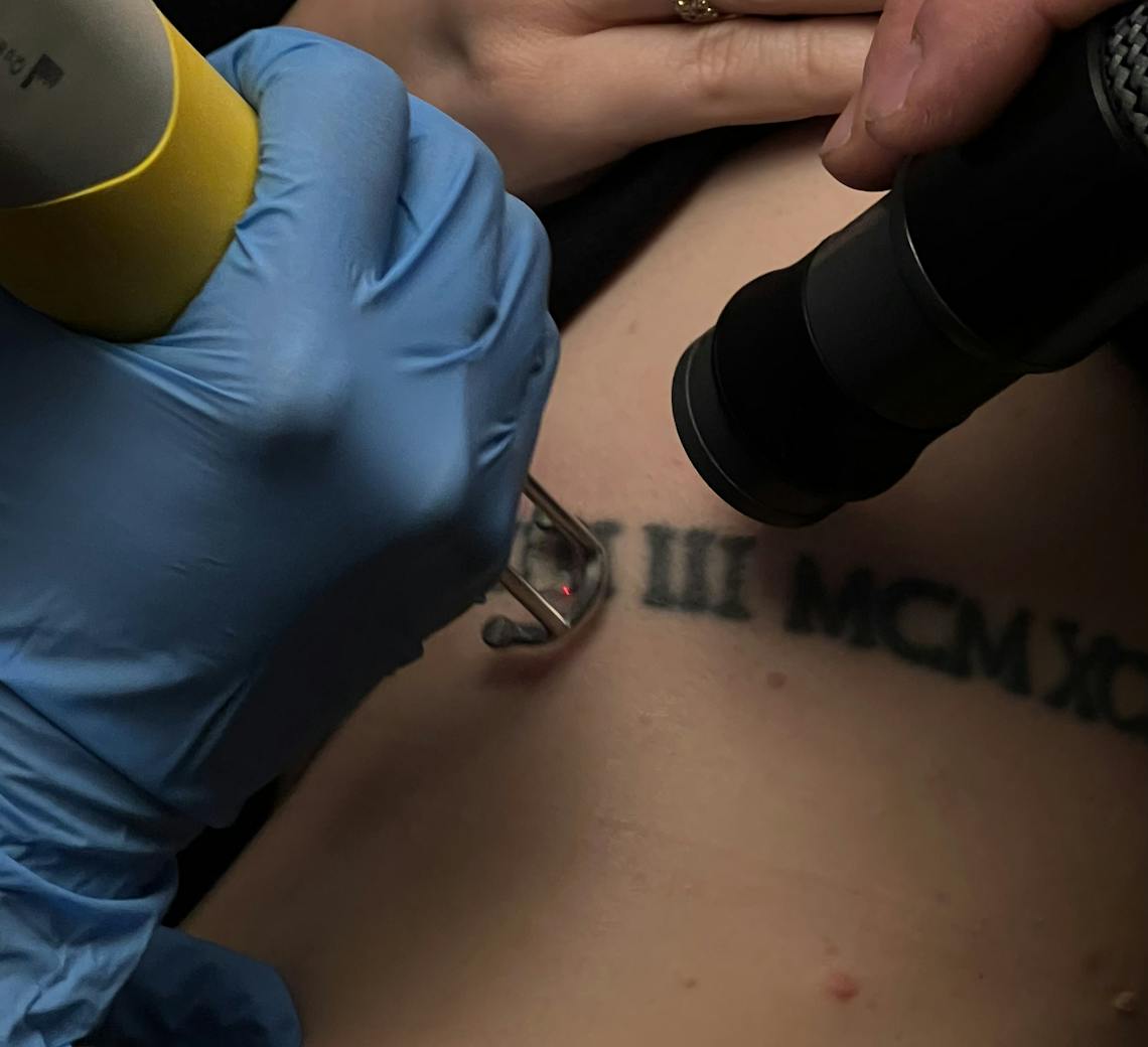 Détatouage dans un centre laser lyon