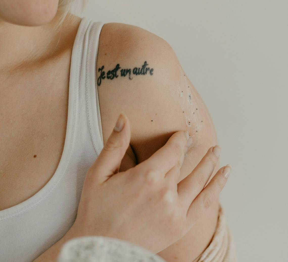 détatouage laser lyon