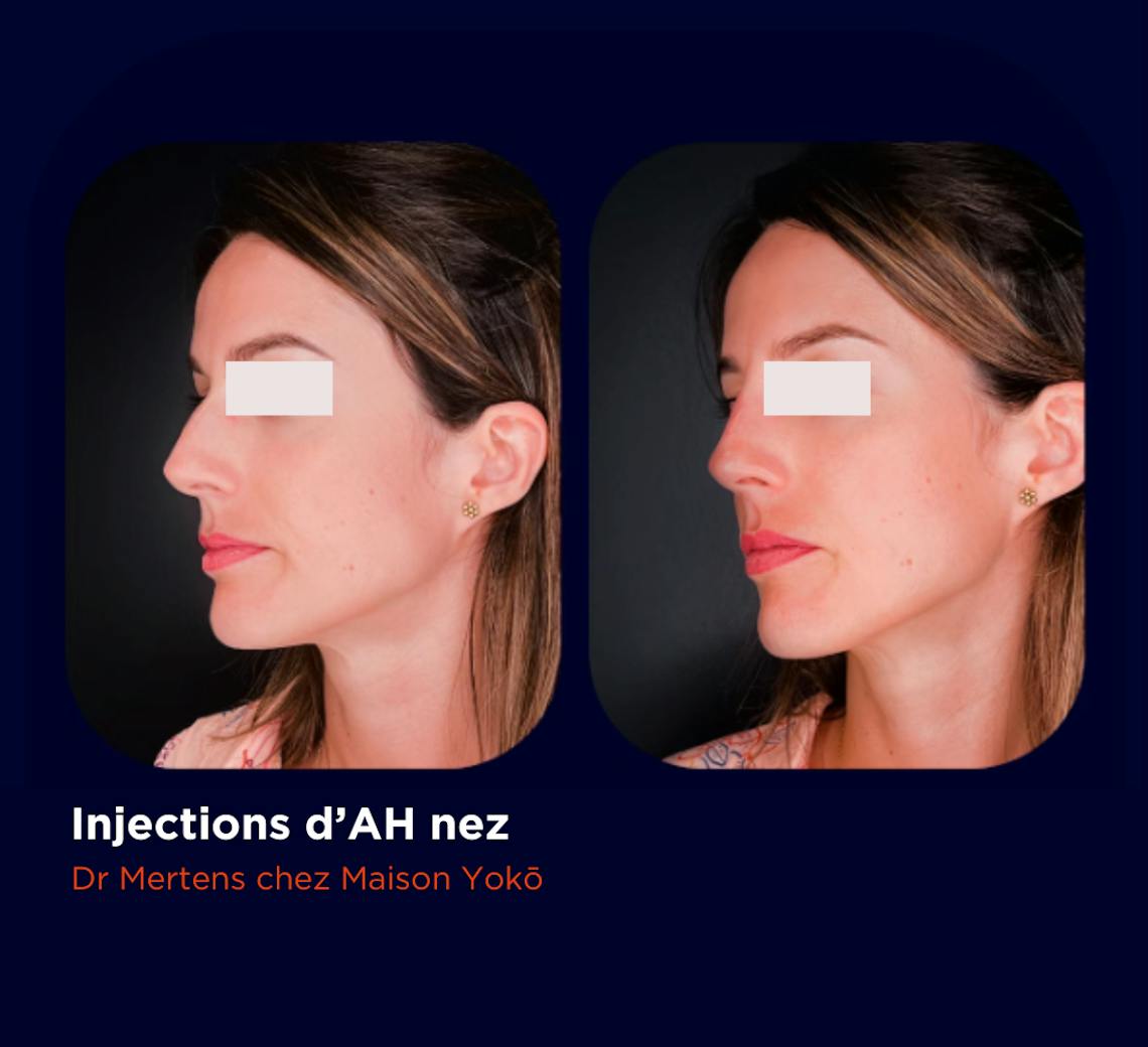 Rhinoplastie médicale grâce à des injections d'acide hyalorunique dans le nez, réalisée dans le centre de médecine esthétique Maison Yoko à Lyon