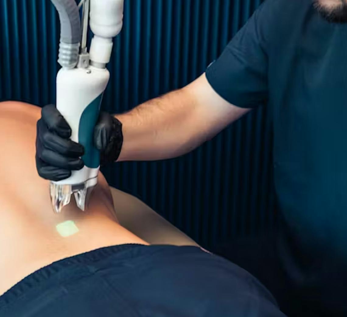 Epilation laser homme pour le dos