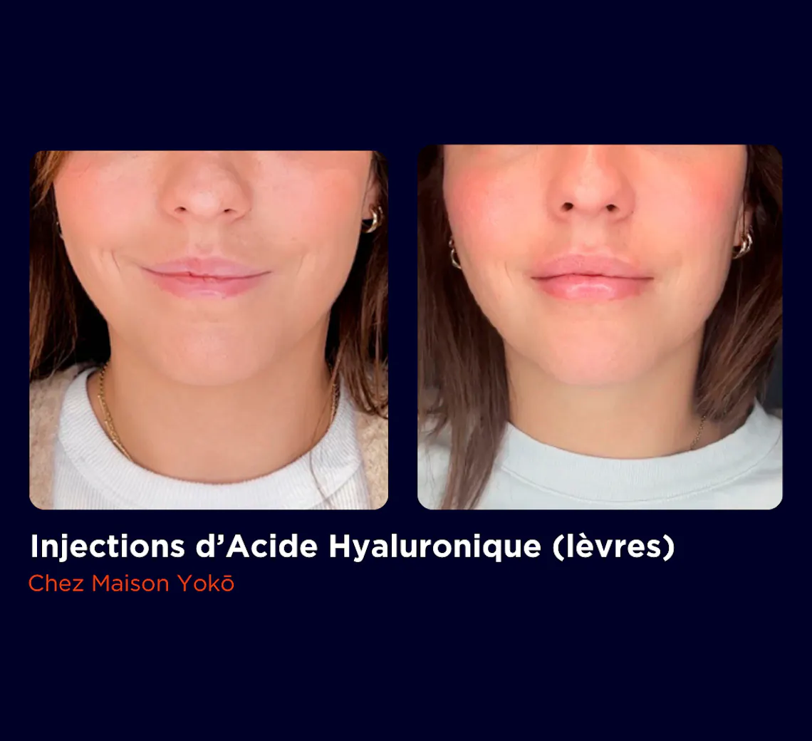 Résultats d'injections d'acide Hyaluronique dans les lèvres d'une patiente chez Maison Yokō à Lyon.
