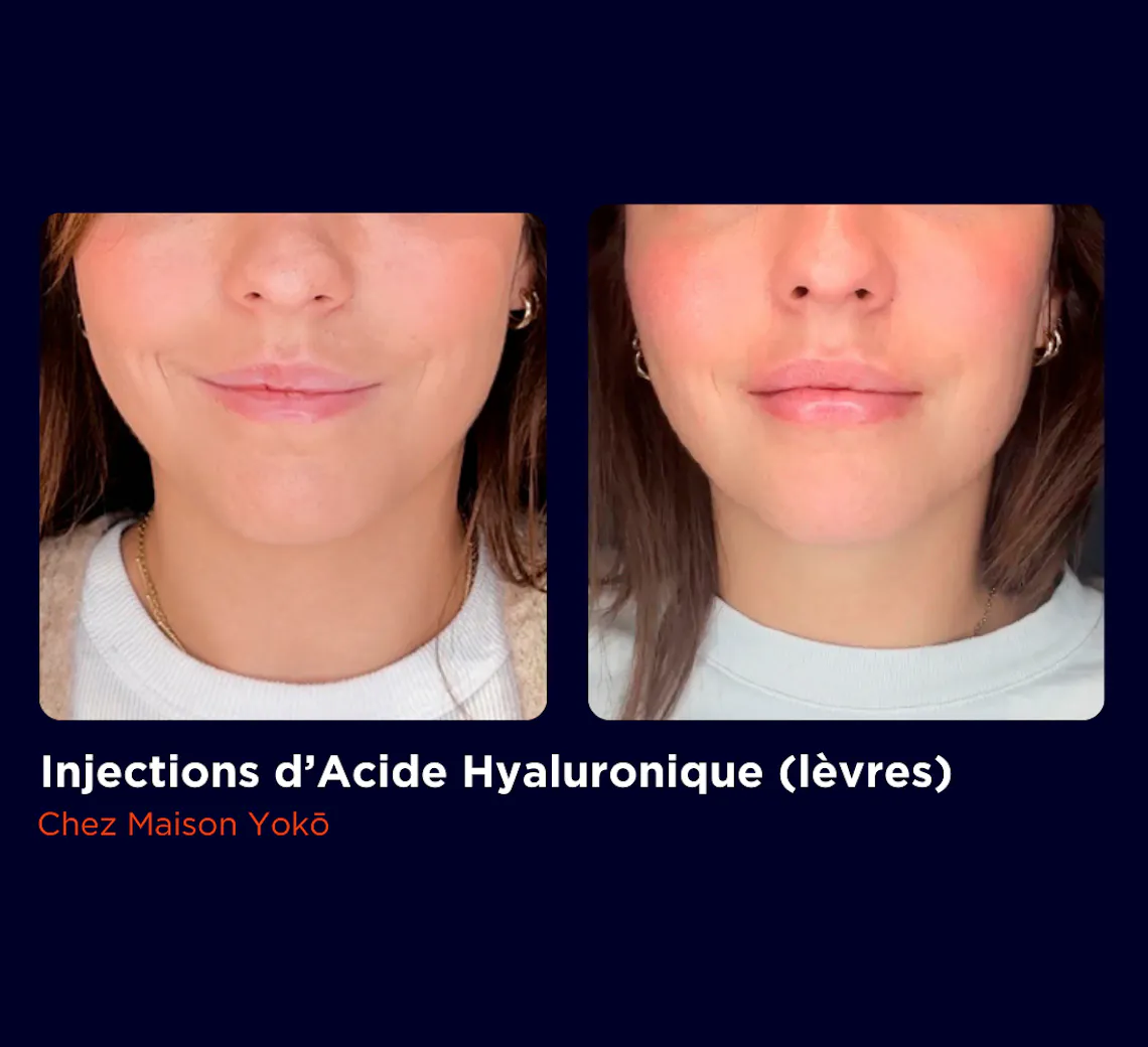 AVANT APRES LEVRES LAURA