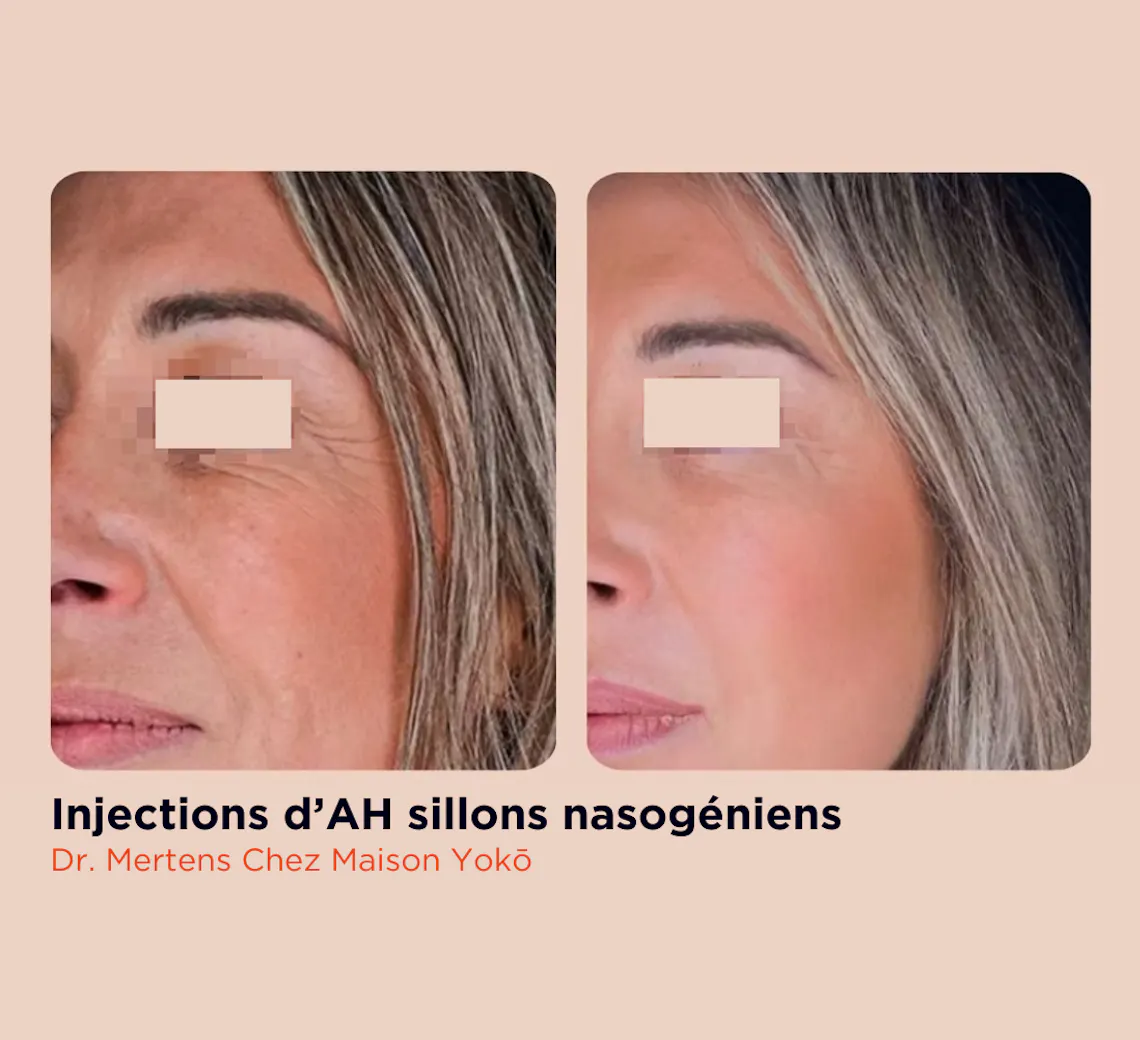 Résultats d'injections d'acide Hyaluronique pour les rides réalisées chez Maison Yokō à Lyon.