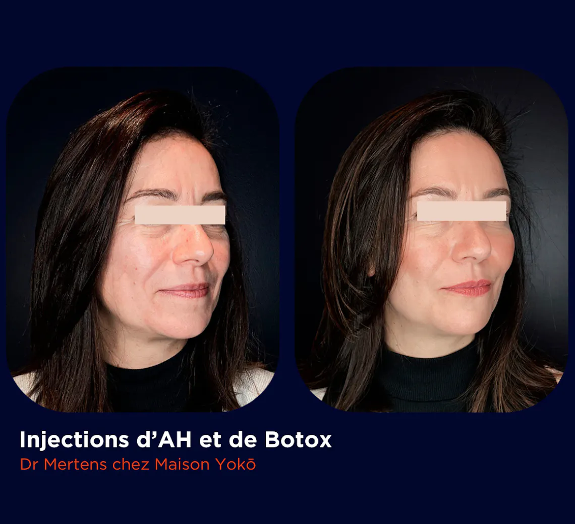 Résultats d'injections d'acide Hyaluronique et de Botox pour les rides chez Maison Yokō à Lyon.