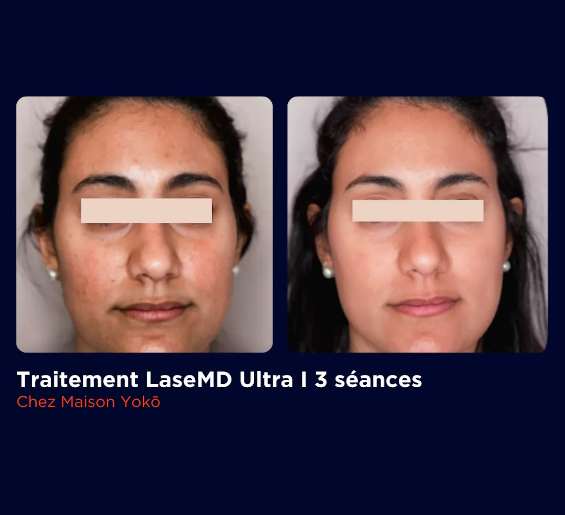 Avantaprès - LASE MD