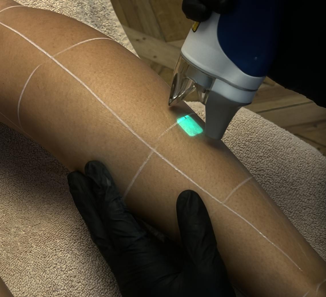 prix épilation laser jambes lyon