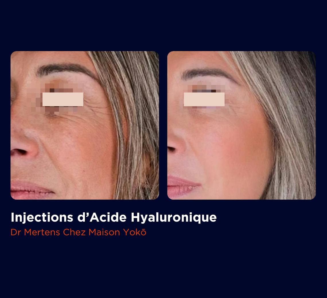 Résultat avant après d'injections d'acide hyaluronique dans les sillons naseaugéniens, par le Dr Mertens à Lyon au centre de médecine esthétique et laser Maison Yoko