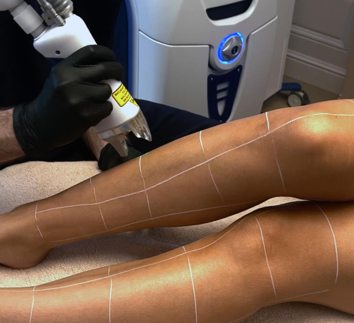 épilation laser des jambes lyon