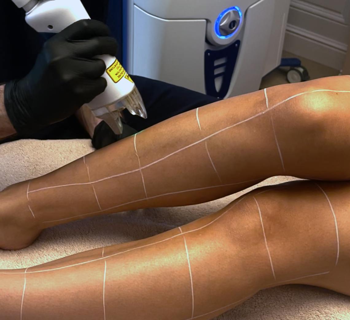 soin epilation au laser lyon