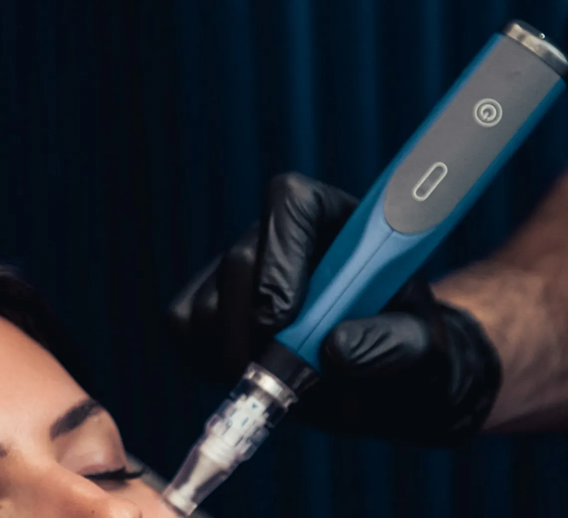Radiofréquence microneedling