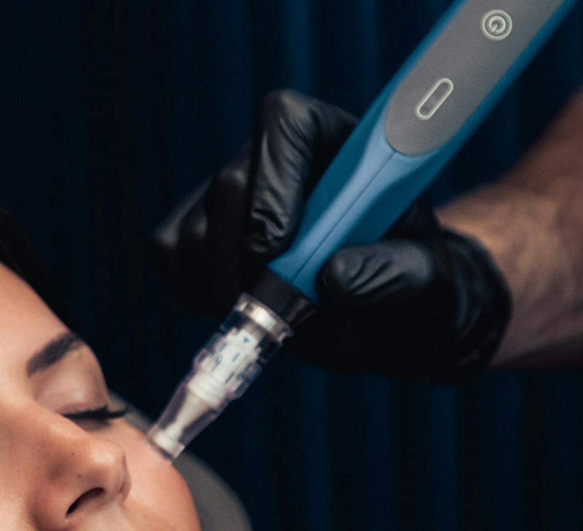 Patiente durant une séance de microneedling avec un expert à Lyon.