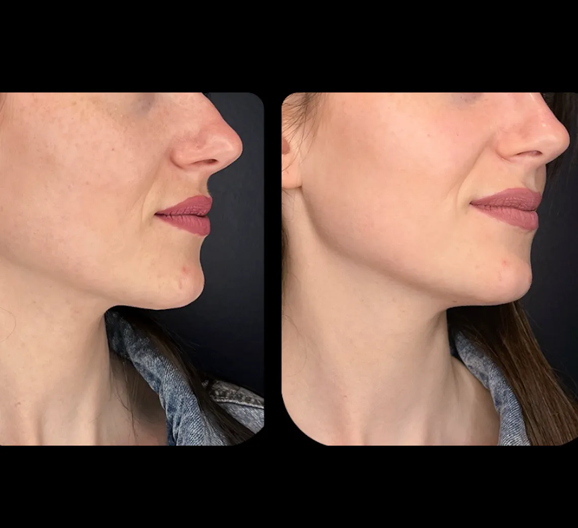 avant après médecine esthétique