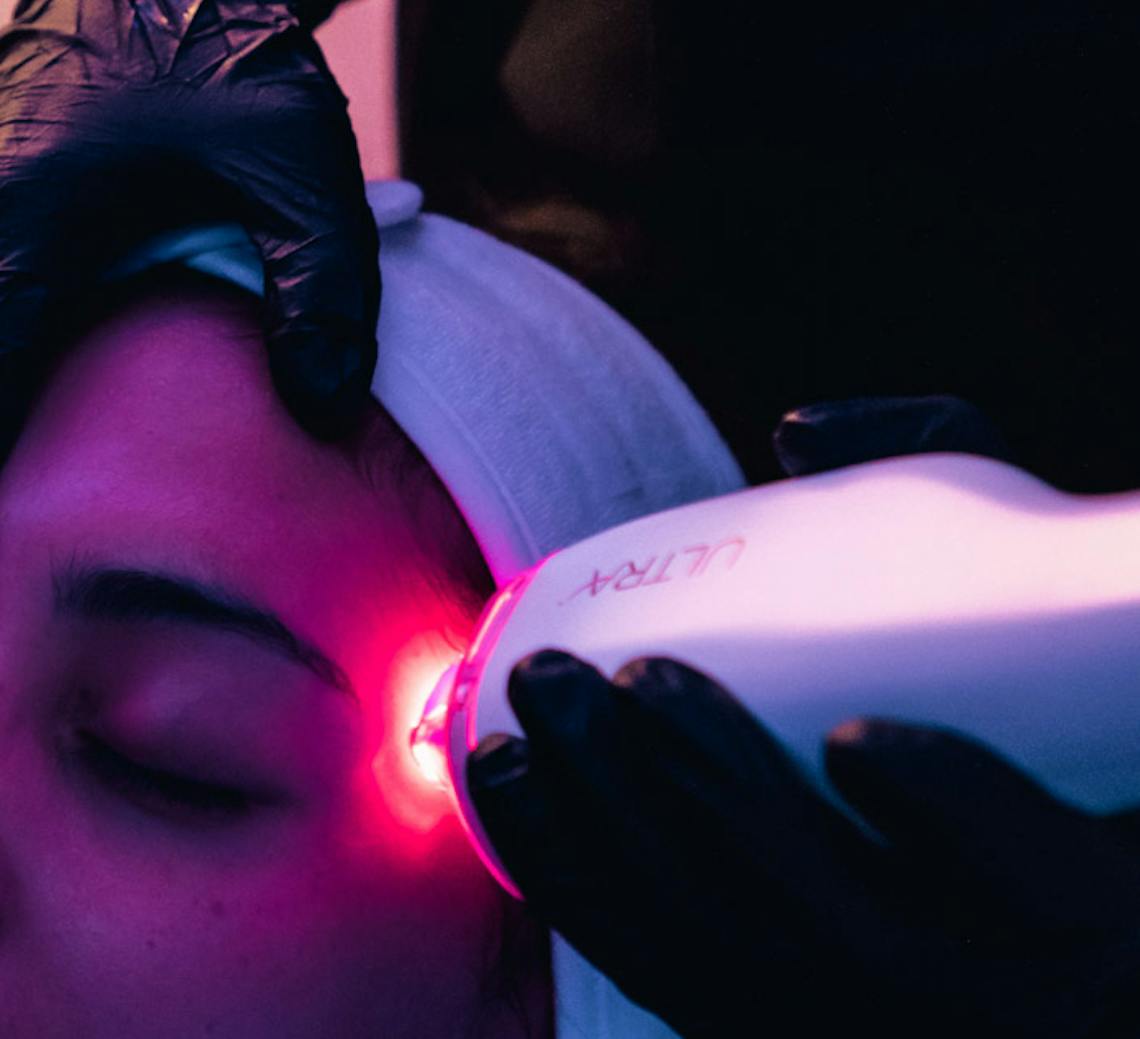 laser visage anti age