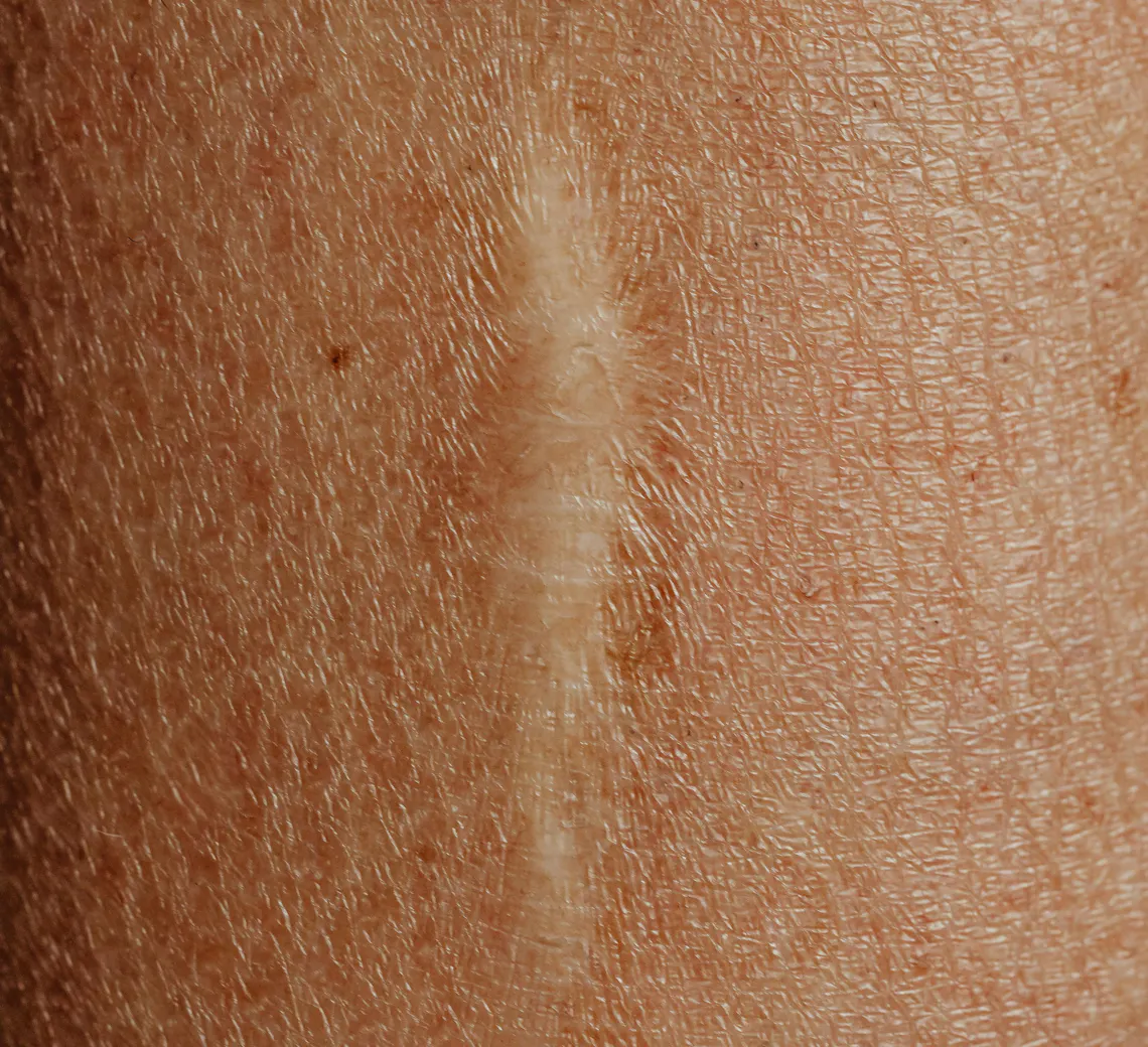 Le laser détatouage ne laisse généralement ni de marques ni de cicatrices si les indications sont bien suivies.