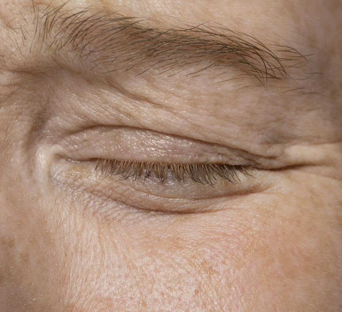 Quelles zones peut-on cibler avec l’acide hyaluronique autour des yeux ?