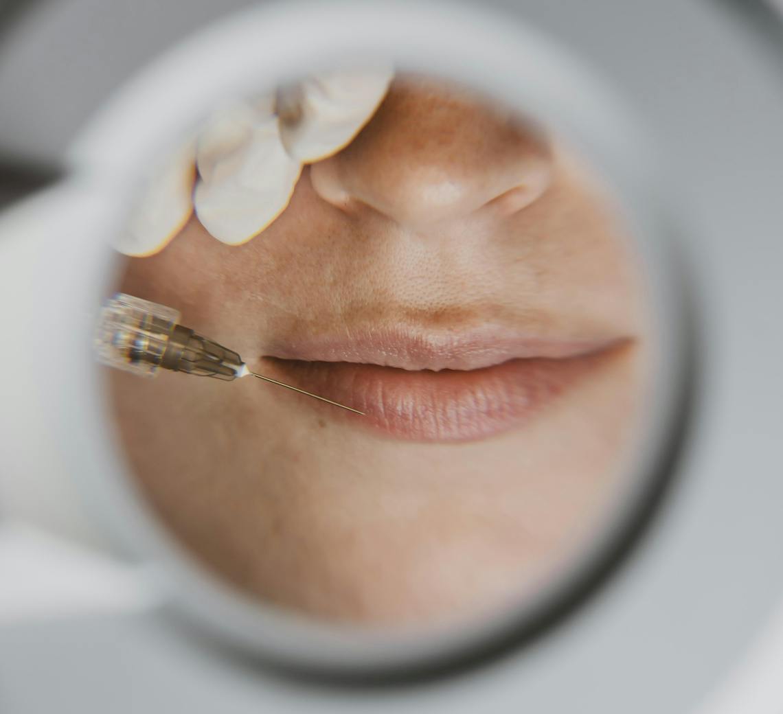 Bouche de jeune femme qui va réaliser des injections au niveau des lèvres.