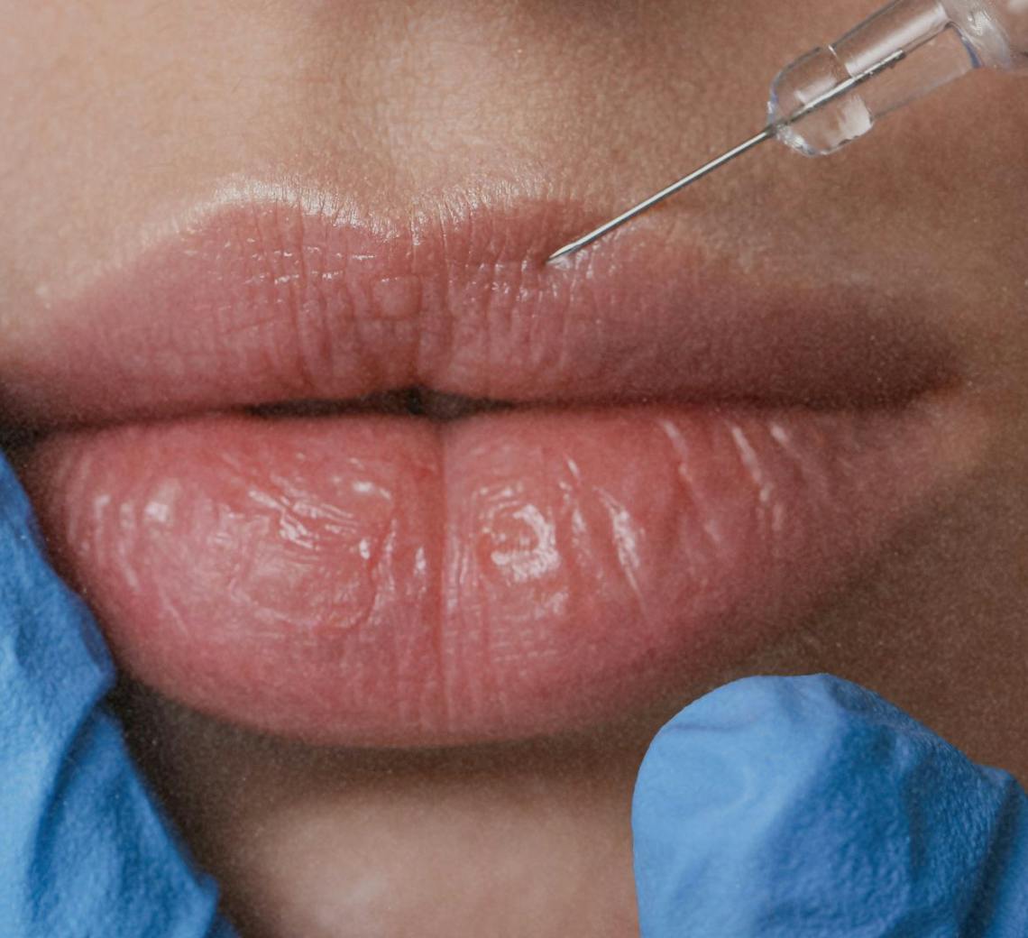injections dans les lèvres à Lyon