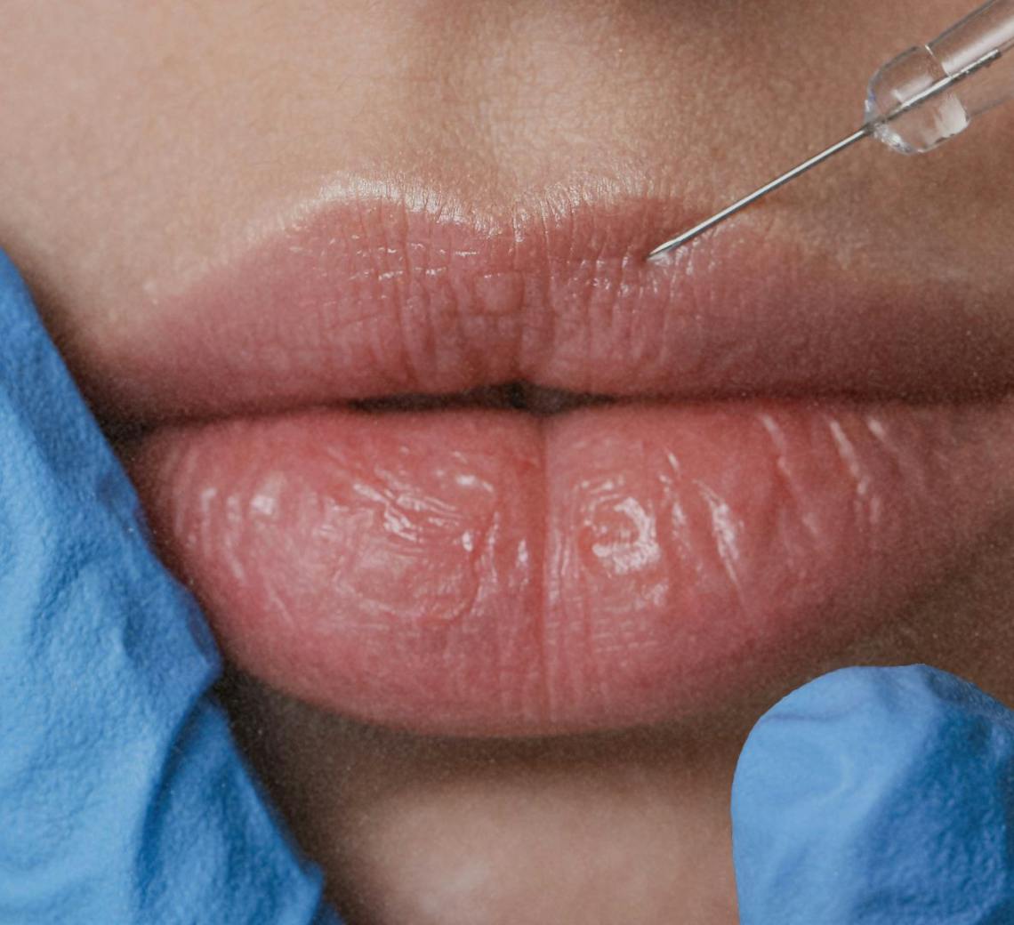 injection d'acide hyaluronique dans les lèvres