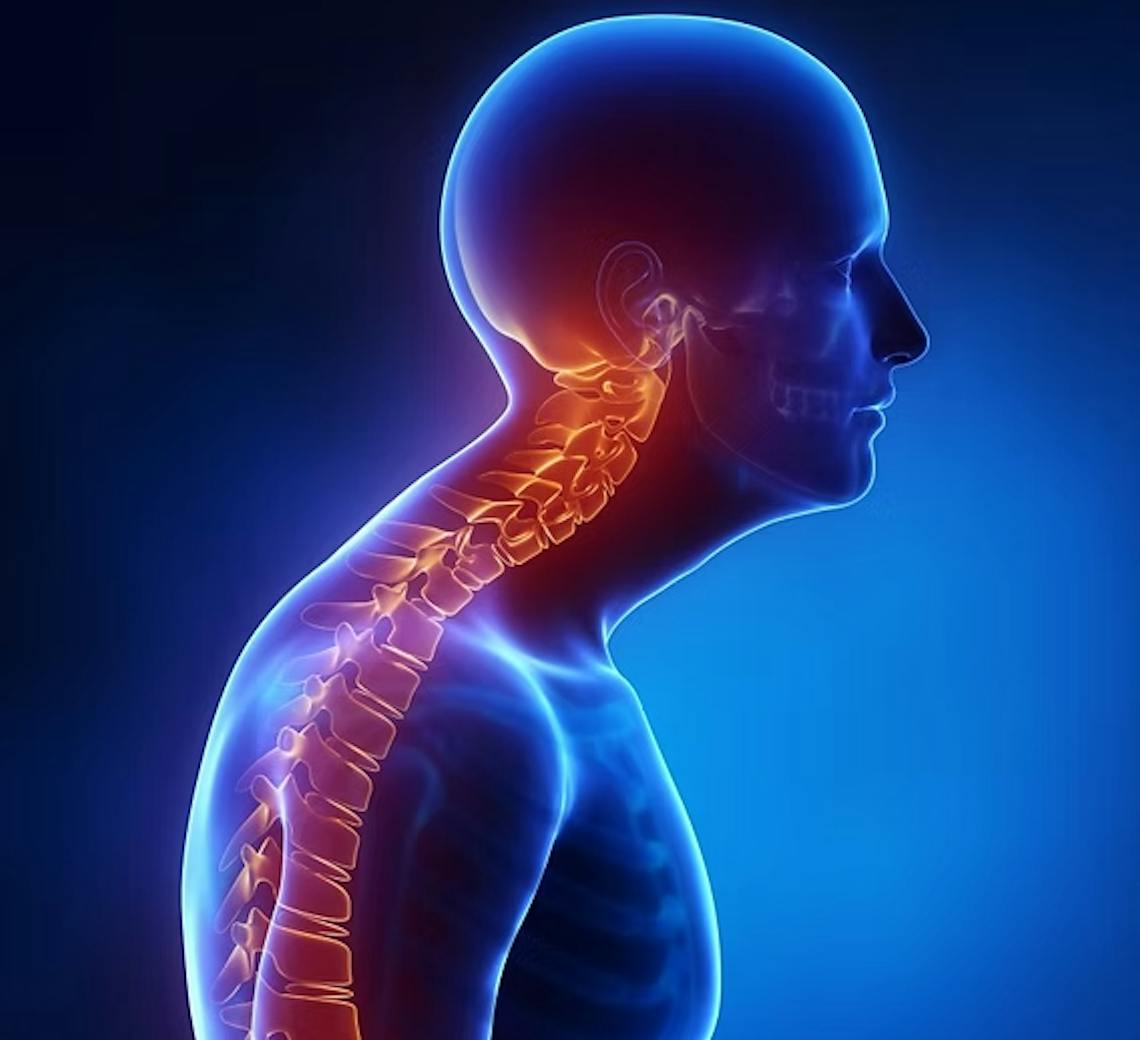 Syndrome du cou de tortue.