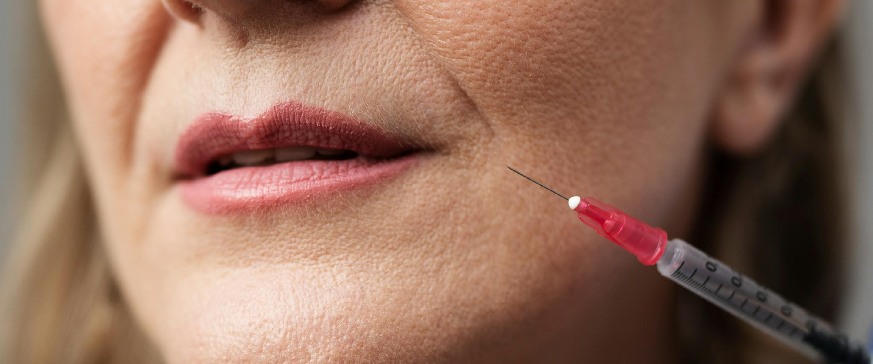 injections lyon acide hyaluronique ou botox lyon