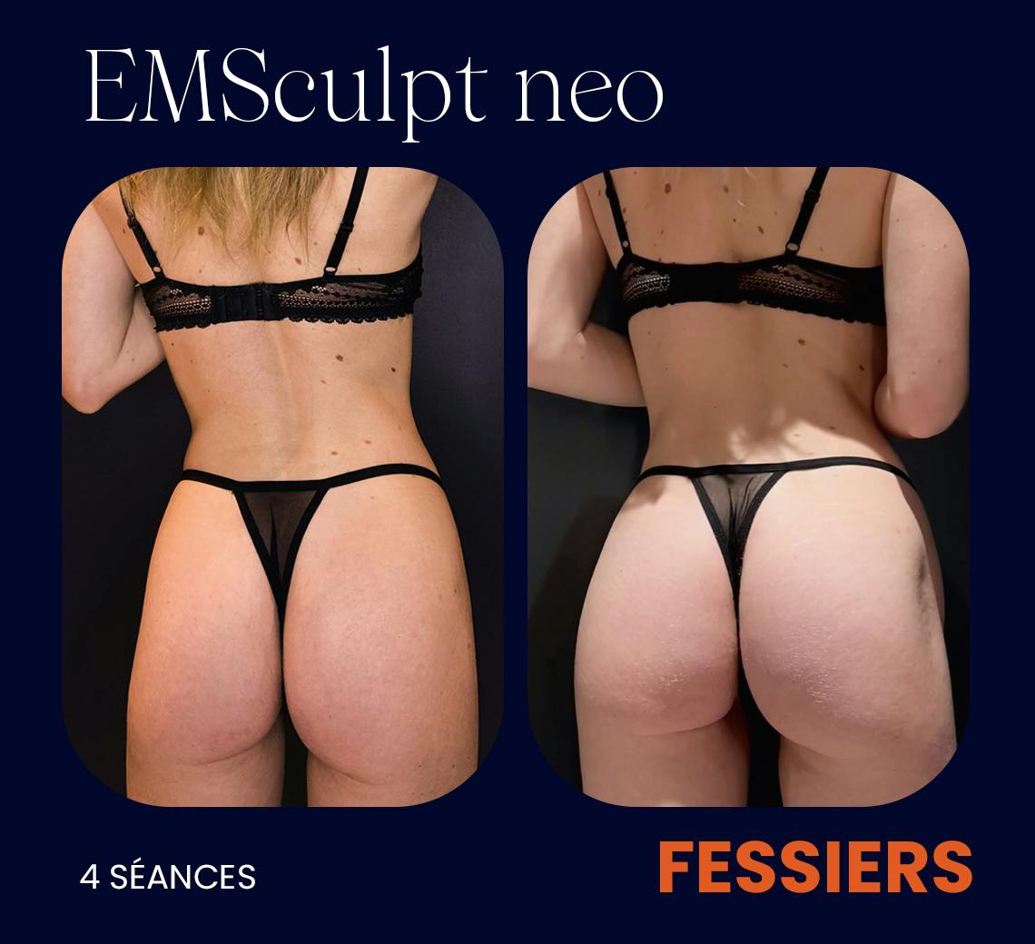 Avant après EMsculpt Neo Maison Yoko