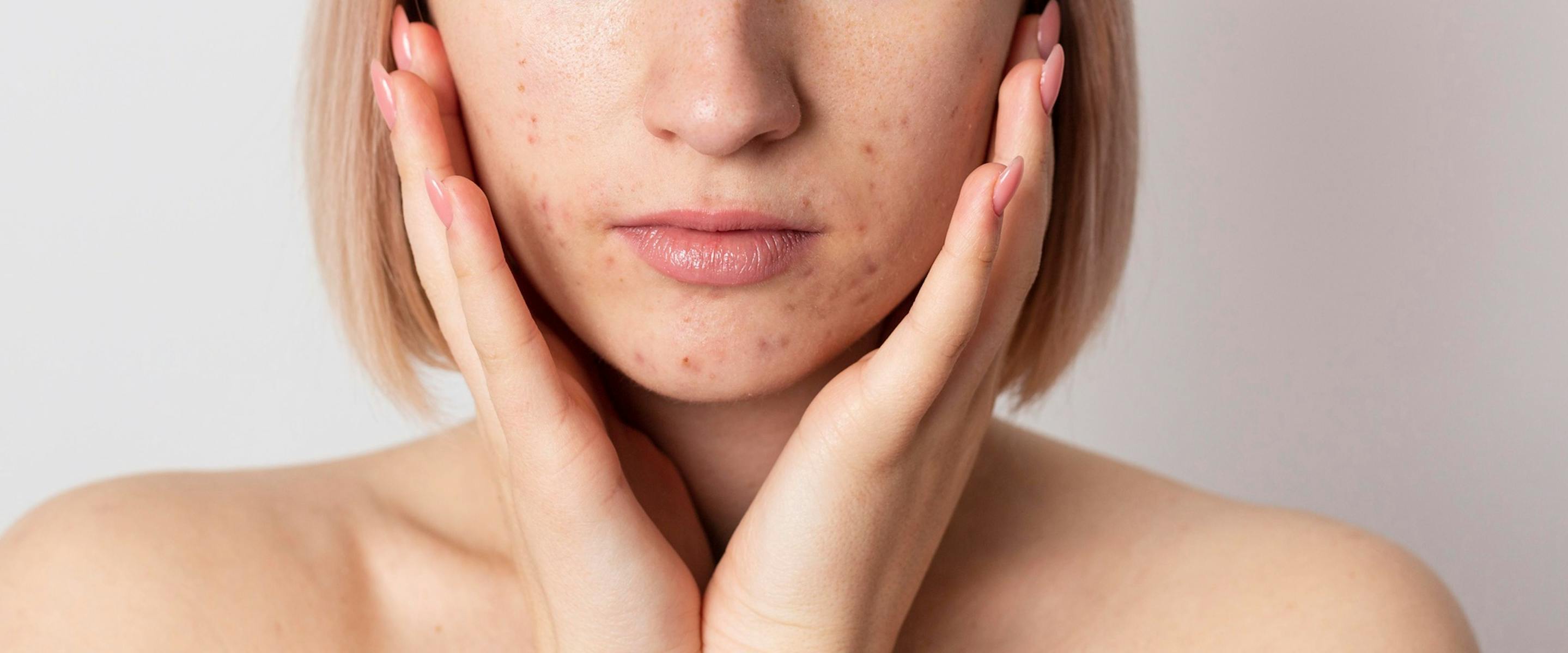 traiter les pores dilatés