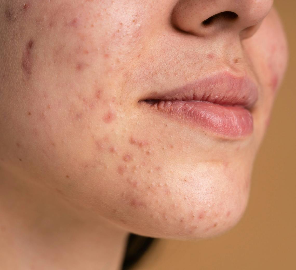 traiter pores dilatés et points noirs