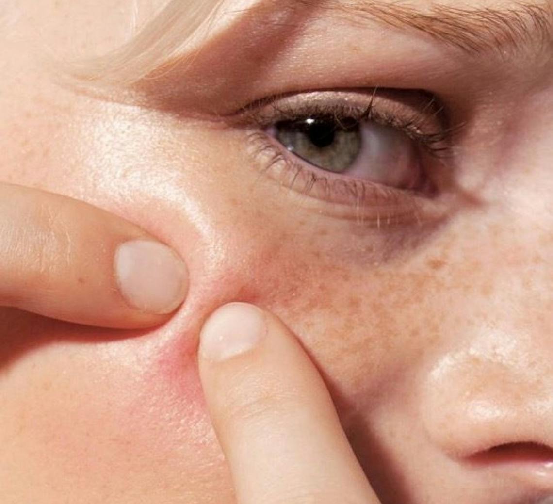 Douleur injection botox