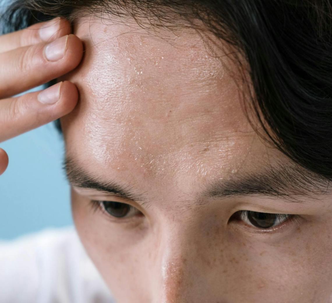 botox solution transpiration excessive