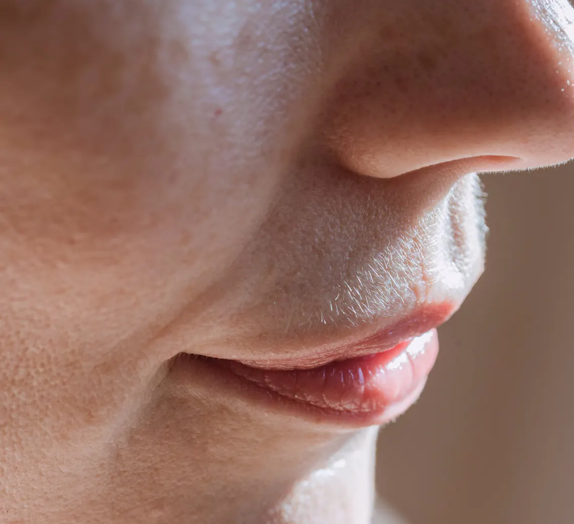 Injection AH dans les lèvres