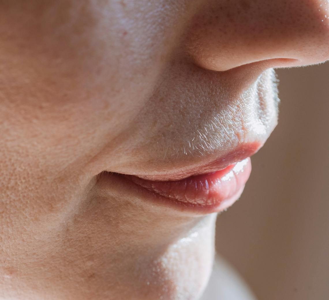 combien de séances de laser co2 pour faire disparaître les cicatrices d'acné