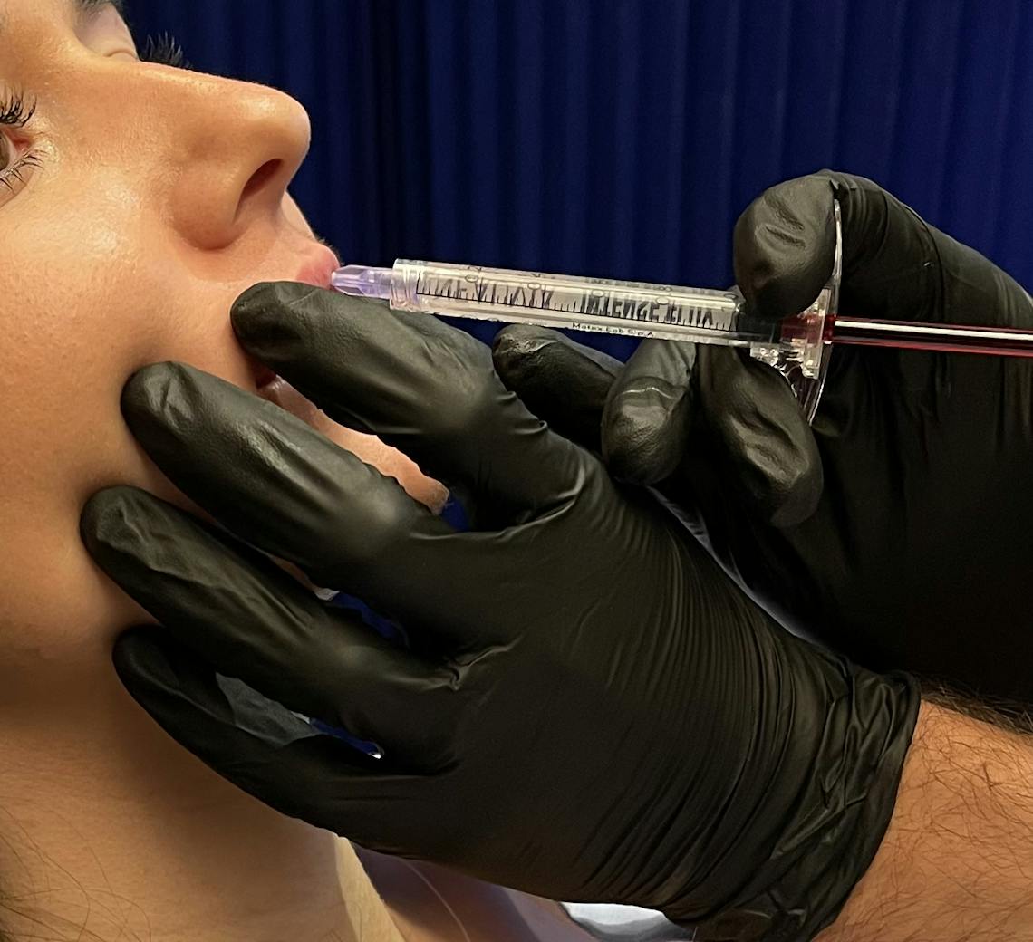 Injection d'acide hyaluronique dans les lèvres d'une patiente par un médecin chez Maison Yoko