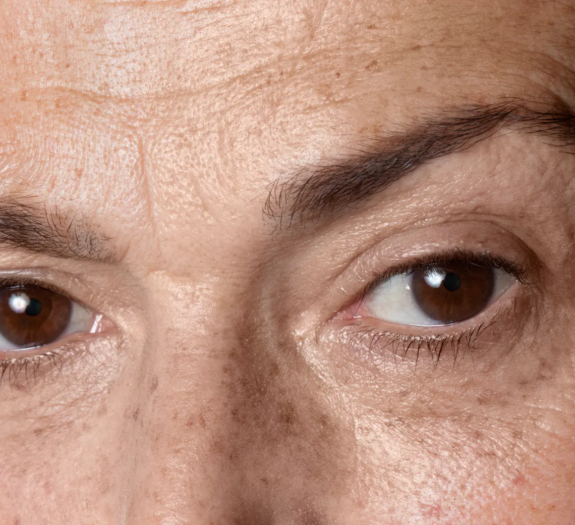 botox pour les rides sous les yeux | botox rides du front