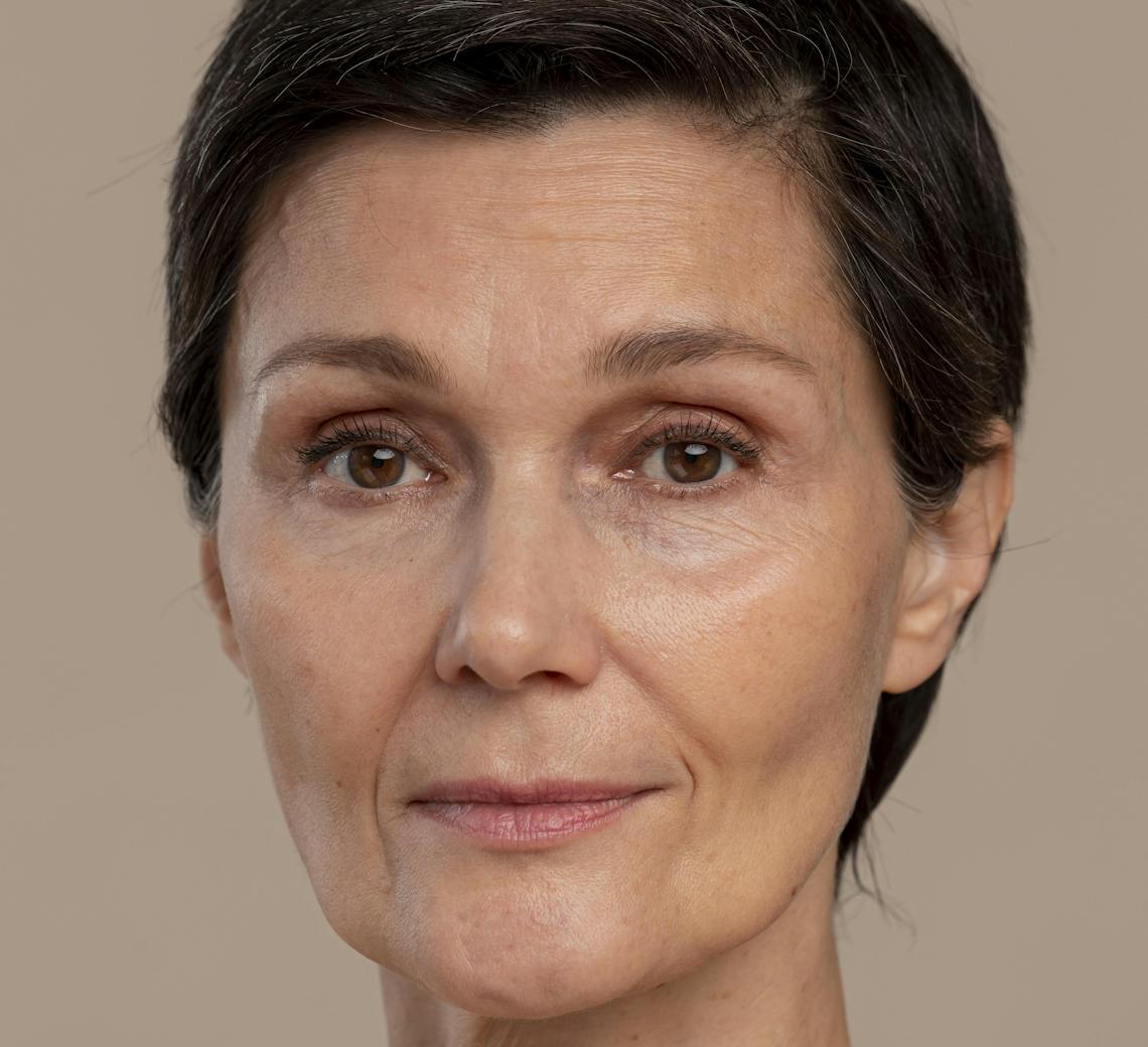 comment lisser les rides | Laser co2 pour les rides