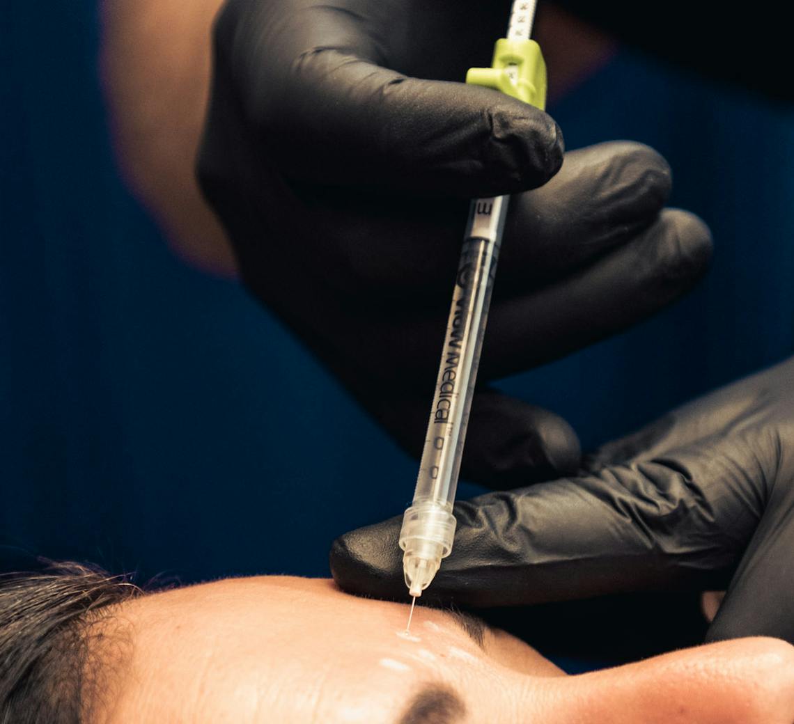 injection de botox pour combler les rides