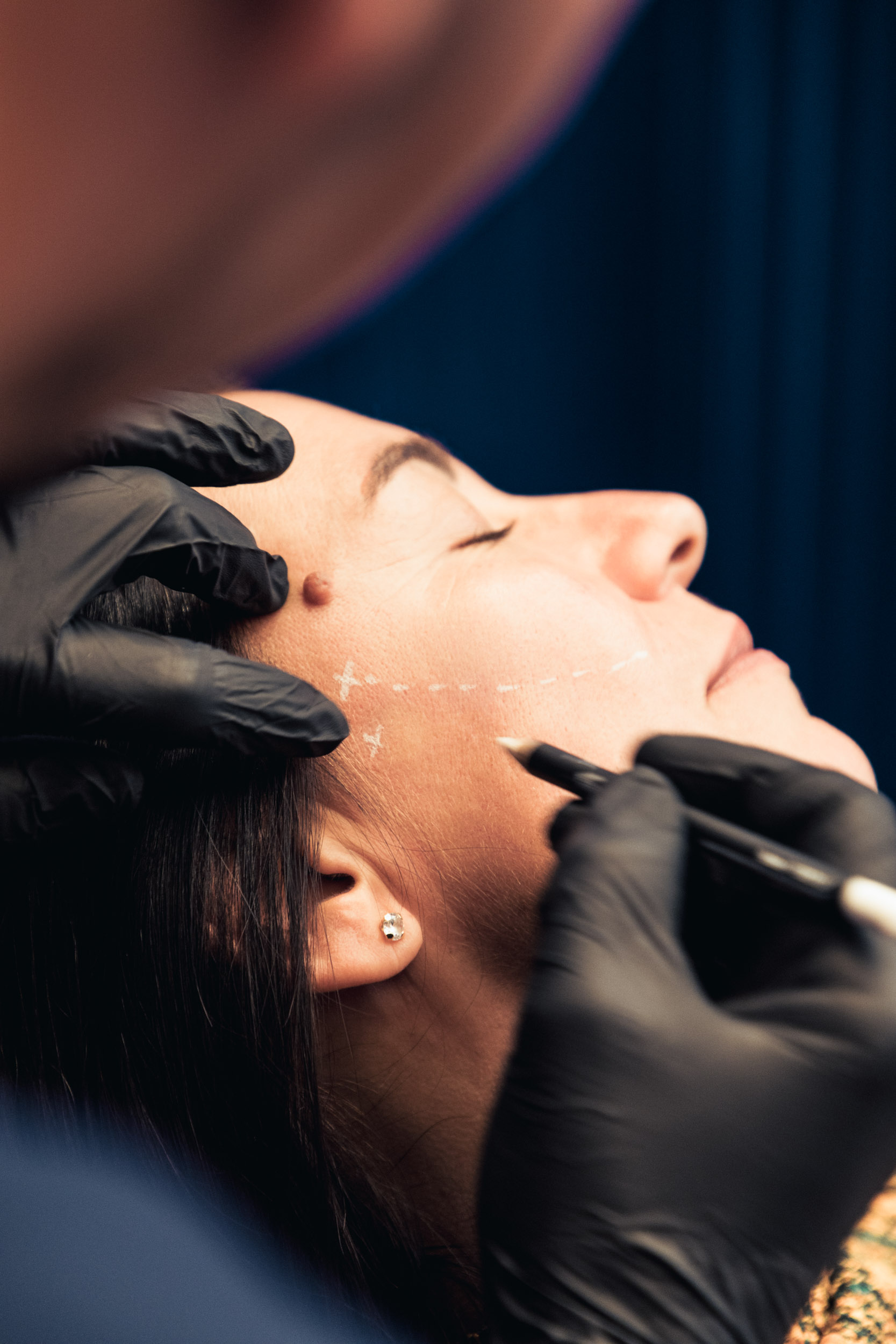 préjugés sur les injections de botox