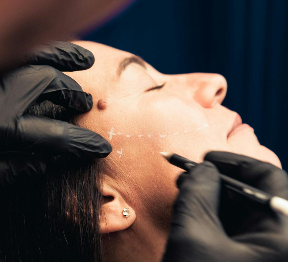 préjugés sur les injections de botox
